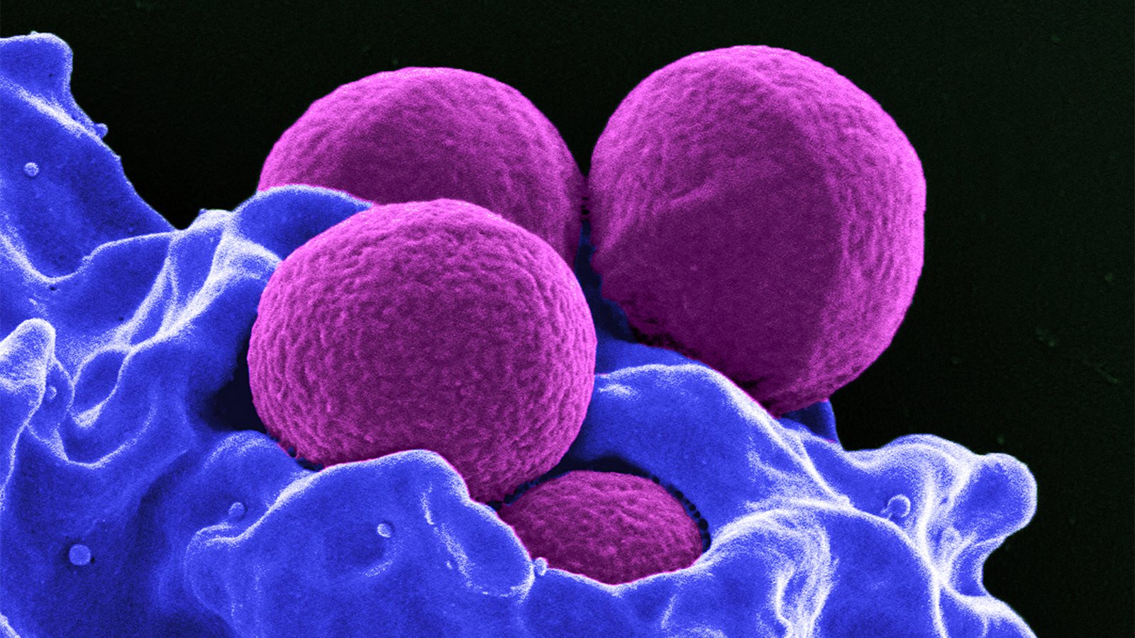 Study 'Challenges' Standard of Prolonged Antibiotics for Orthopedic Infections