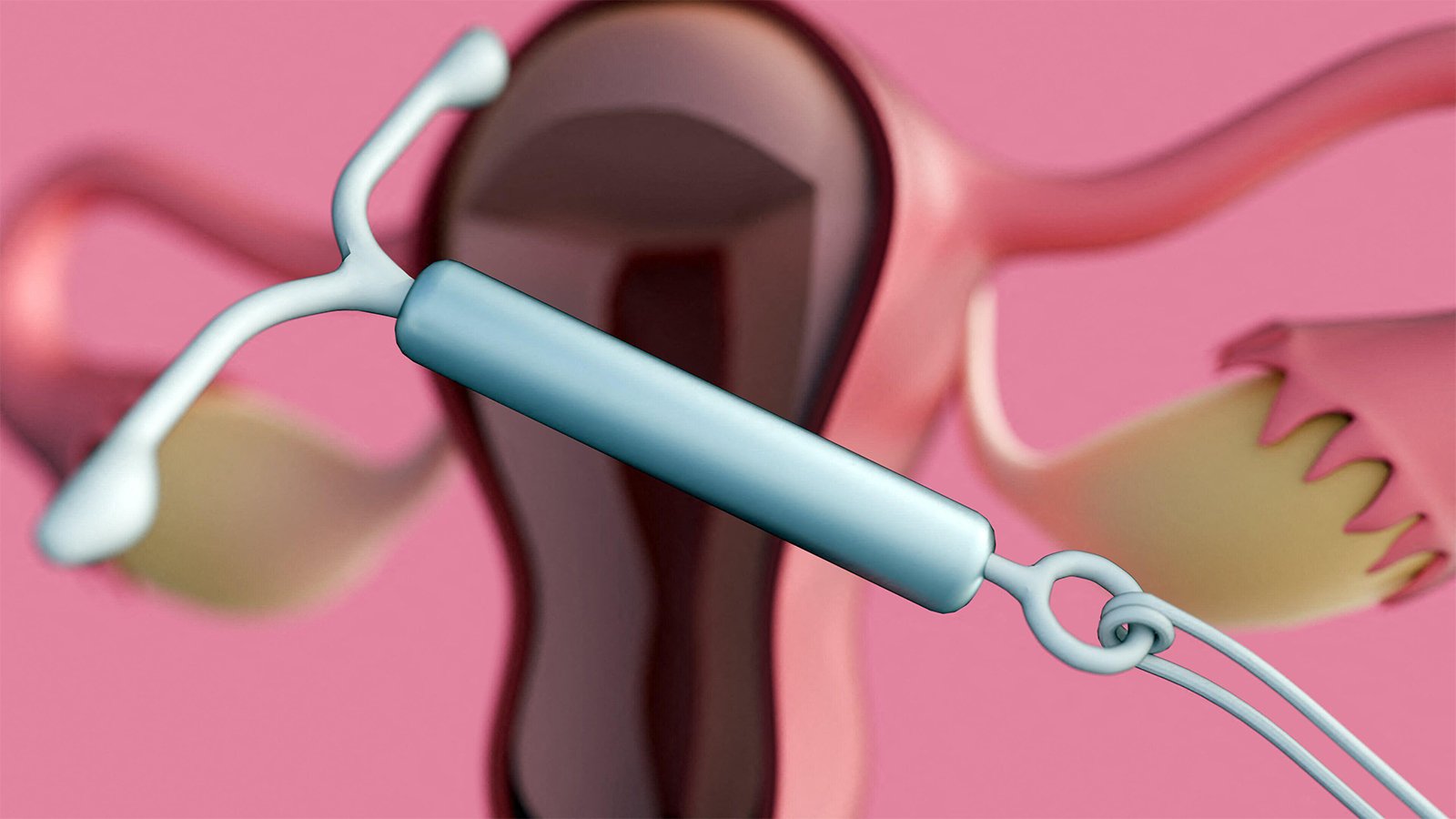 Trial Supports New Method for Easing IUD Insertion Pain